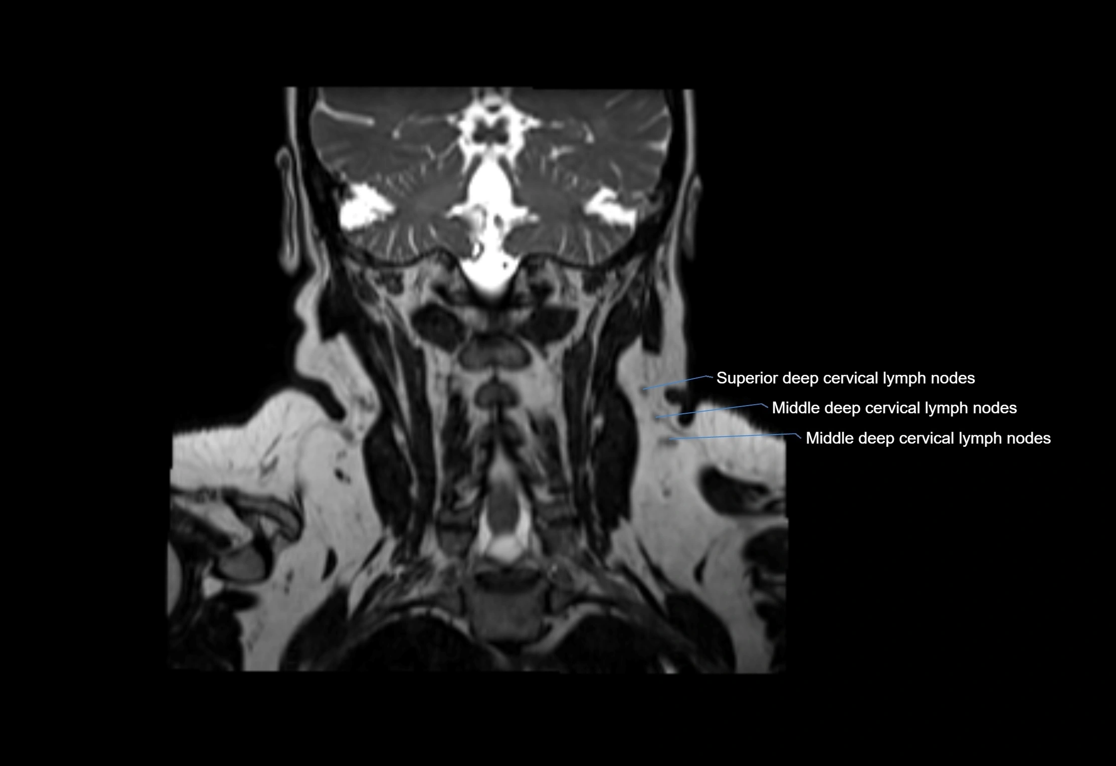 Neck coronal lymph node cross sectional MRI anatomy 3T MRI  image-img-00001-00020.webp